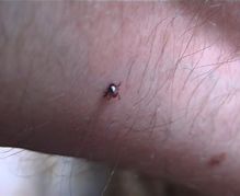 За последнюю неделю медицинская помощь по поводу присасывания клещей оказана 19 зеленогорцам